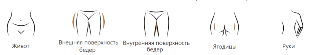 DERMOLIPO RF зоны воздействия