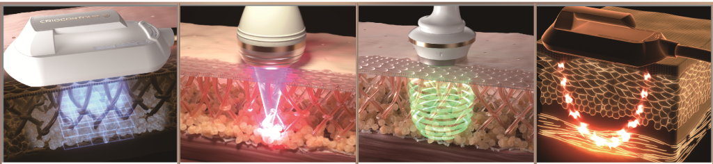 Divashape body treatment